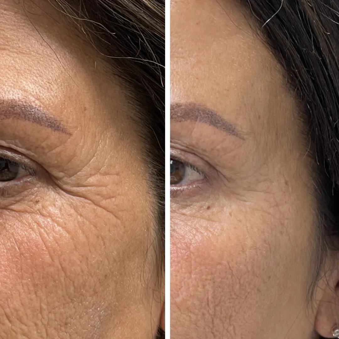 Hydra Glow Express - Serum Acide Hyaluronique - Hyaluro Filler