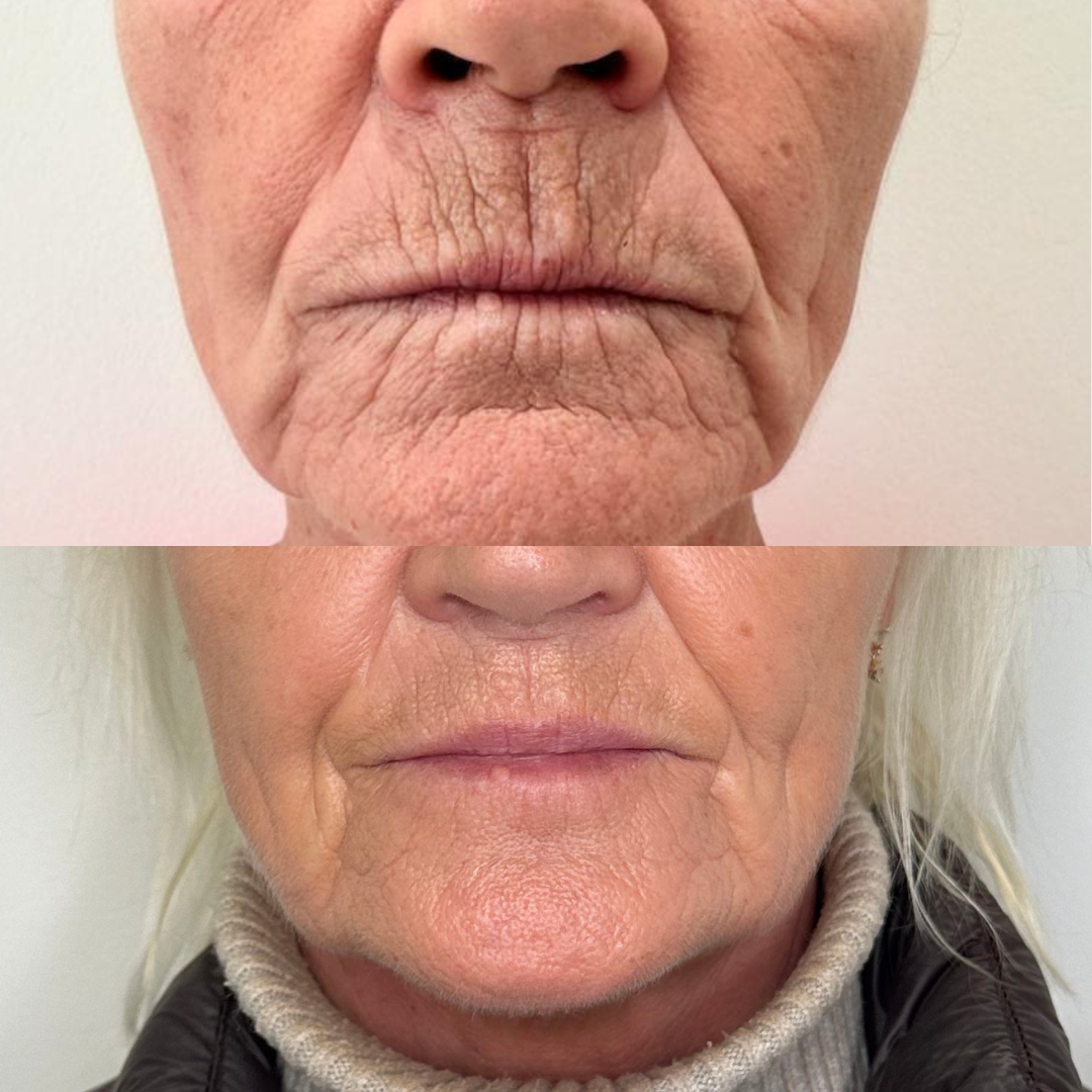 Hydra Glow Express - Serum Acide Hyaluronique - Hyaluro Filler