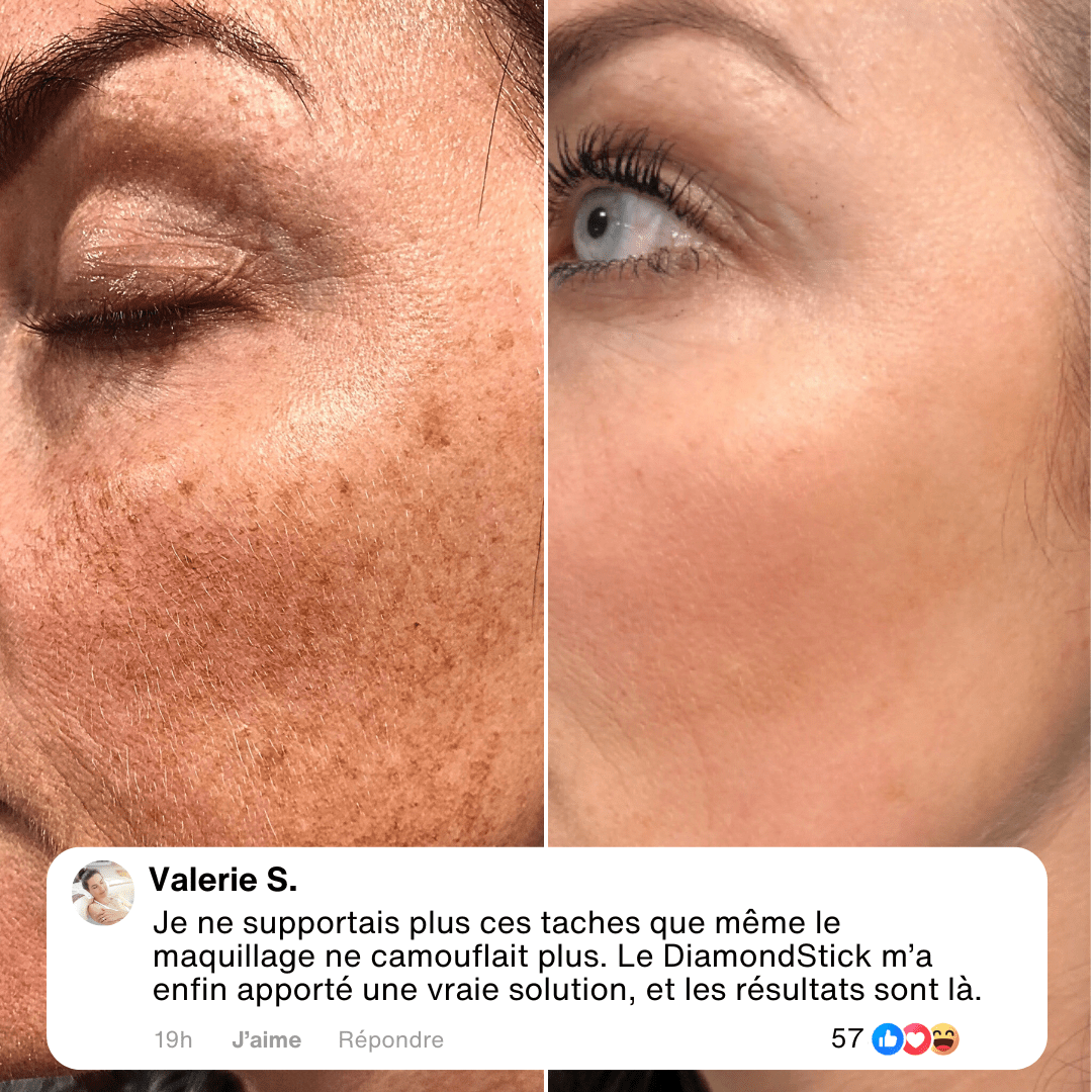 Le Diamondstick® - Le Peeling nouvelle génération